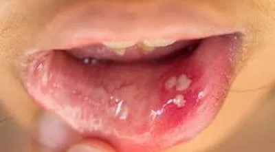 کپسول AHCC کینوکو گلد طلایی AHCC Kinoko Gold 7 زگیل های ویروس hpv در داخل دهان مری و حلق