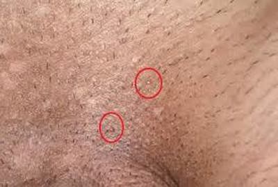 عکس واضح از زگیل تناسلی های مخفی روی پوست