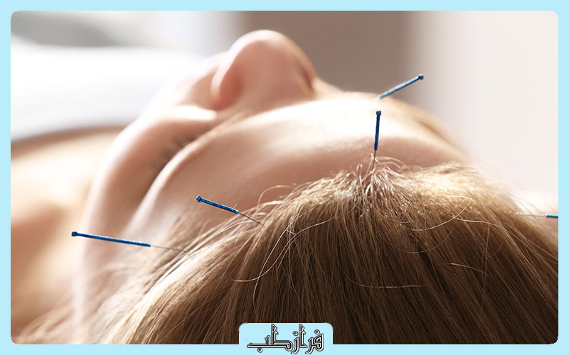 آیا طب سوزنی در درمان میگرن موثر است؟ 2 طب سوزنی برای میگرن