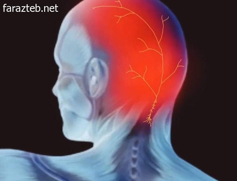 قرص میگراستیل Migrastil 4 نقاط سردرد در میگرن عصبی