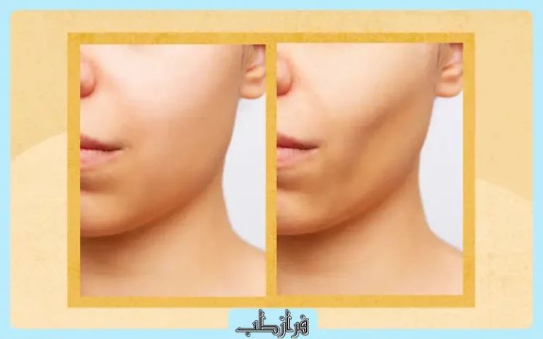 قرص چاقی صورت فت فیس چند روزه جواب می دهد